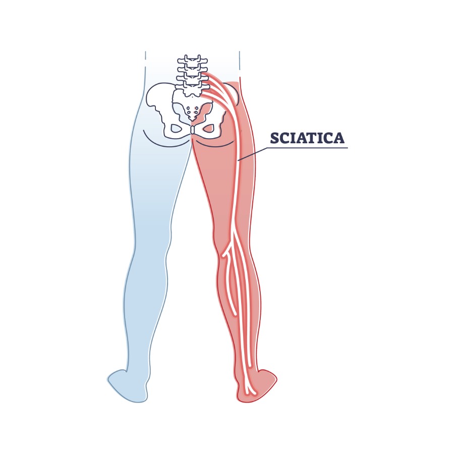 Sciatica pain or nerve